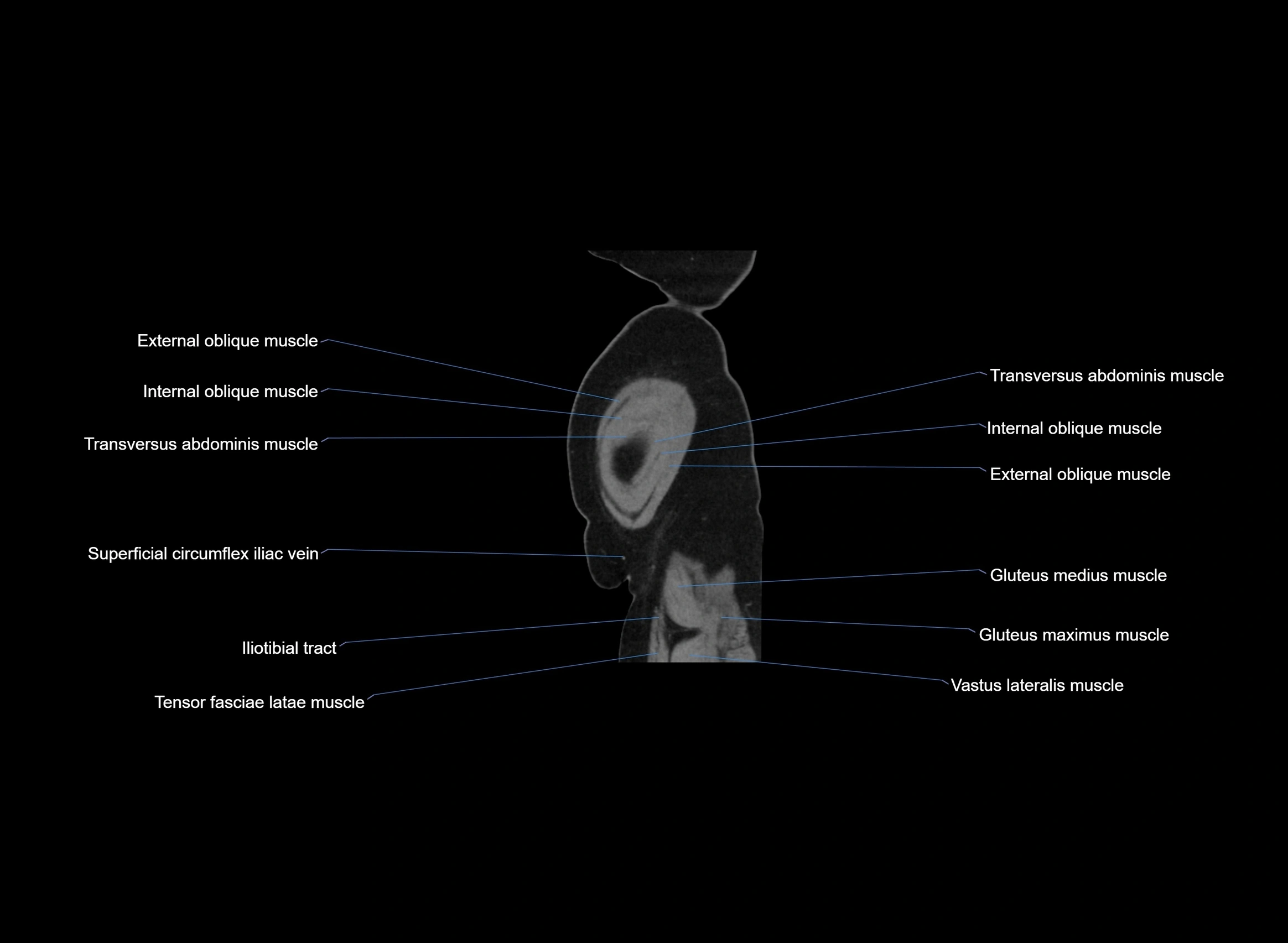 CT Abdomen sagittal cross sectional anatomy labelled radiology image -00007.webp